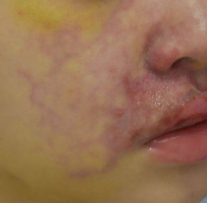 面部注射填充术后血管栓塞并发症系列科普