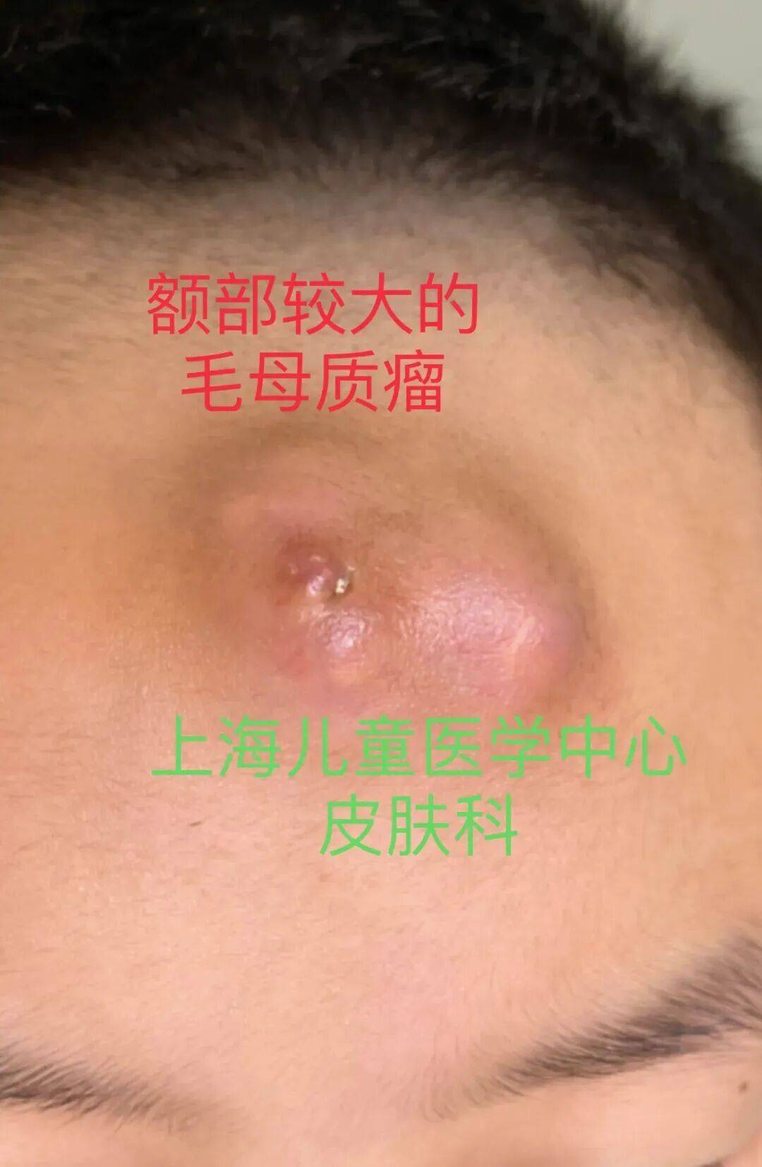 宝宝脸上的蚊子包消不下去?容易被误诊的毛母质瘤