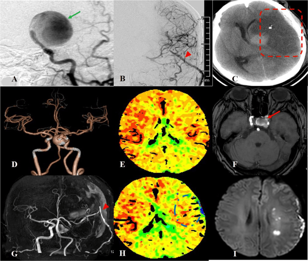 前循环复杂颅内动脉瘤的一期与二期动脉瘤夹闭术结合脑血管