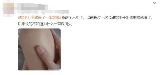 指甲出现这个变化,可能是癌变! 指甲出现这个变化,可能是癌变!