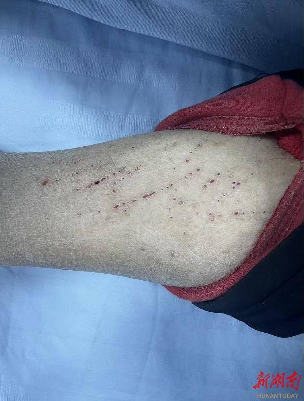 肾病患者皮肤瘙痒难耐？专家支招科学应对