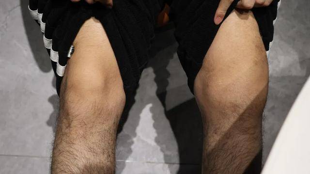 0元购药还能赚钱?血友病患者囤免费"救命药"卷入医保诈骗案(图6)