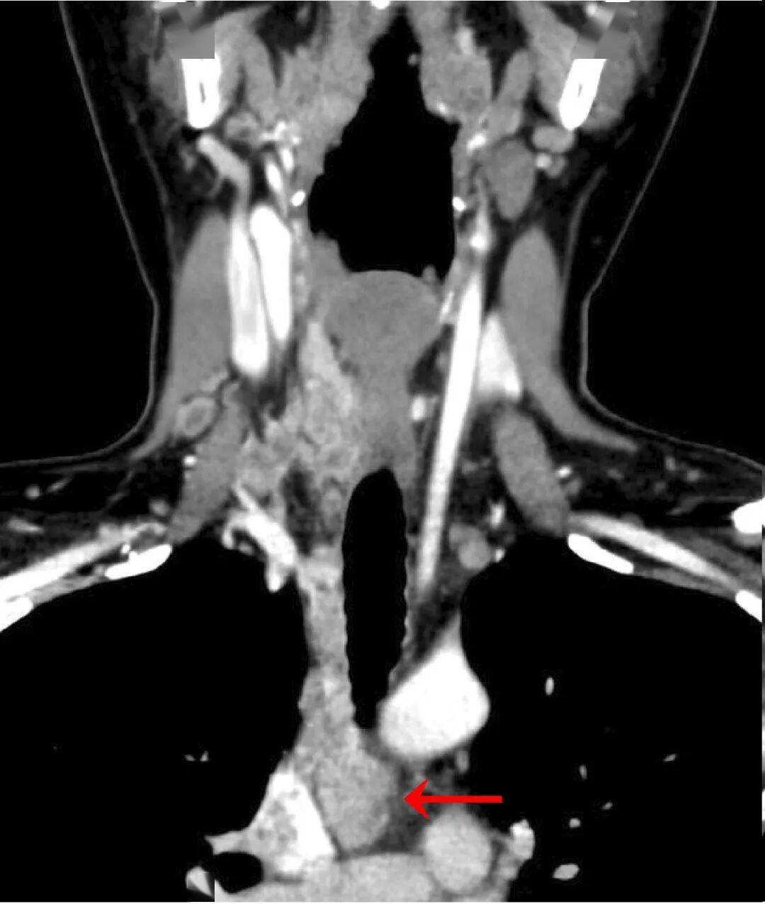 【朝医新闻】普外中心甲状腺颈部外科开创经心包径路晚期甲状腺癌清扫术