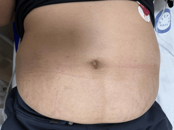 【体重管理】人瘦了，但皮肤留下的“闪电纹”是怎么回事？