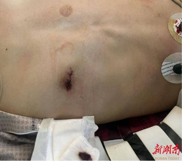 湖南首例！无管麻醉+隐形切口，气胸手术迈入“超微创美学时代”