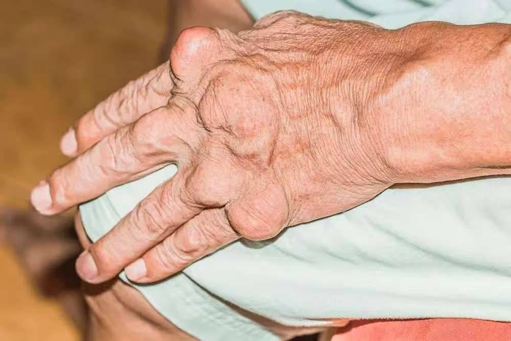 原创            痛风的元凶被查出，海鲜没上榜，第1名大家可能每天都在吃！