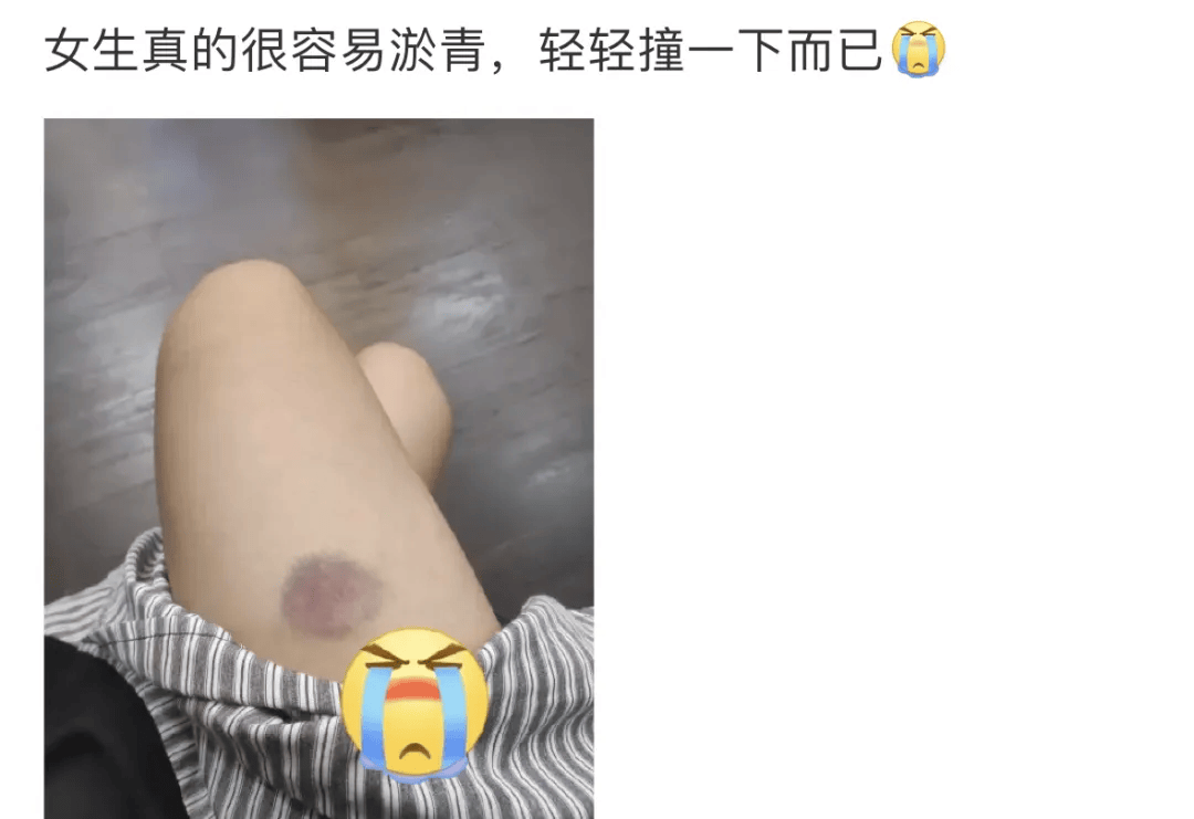 为啥女朋友身上，总是出现莫名的淤青？