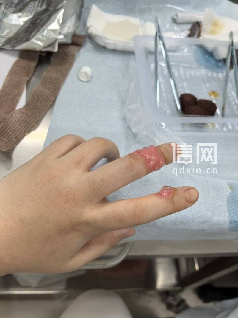 海底捞热汤碗开裂致顾客手指被烫伤 索赔被要求提供银行流水(图1) 文章配图-1
