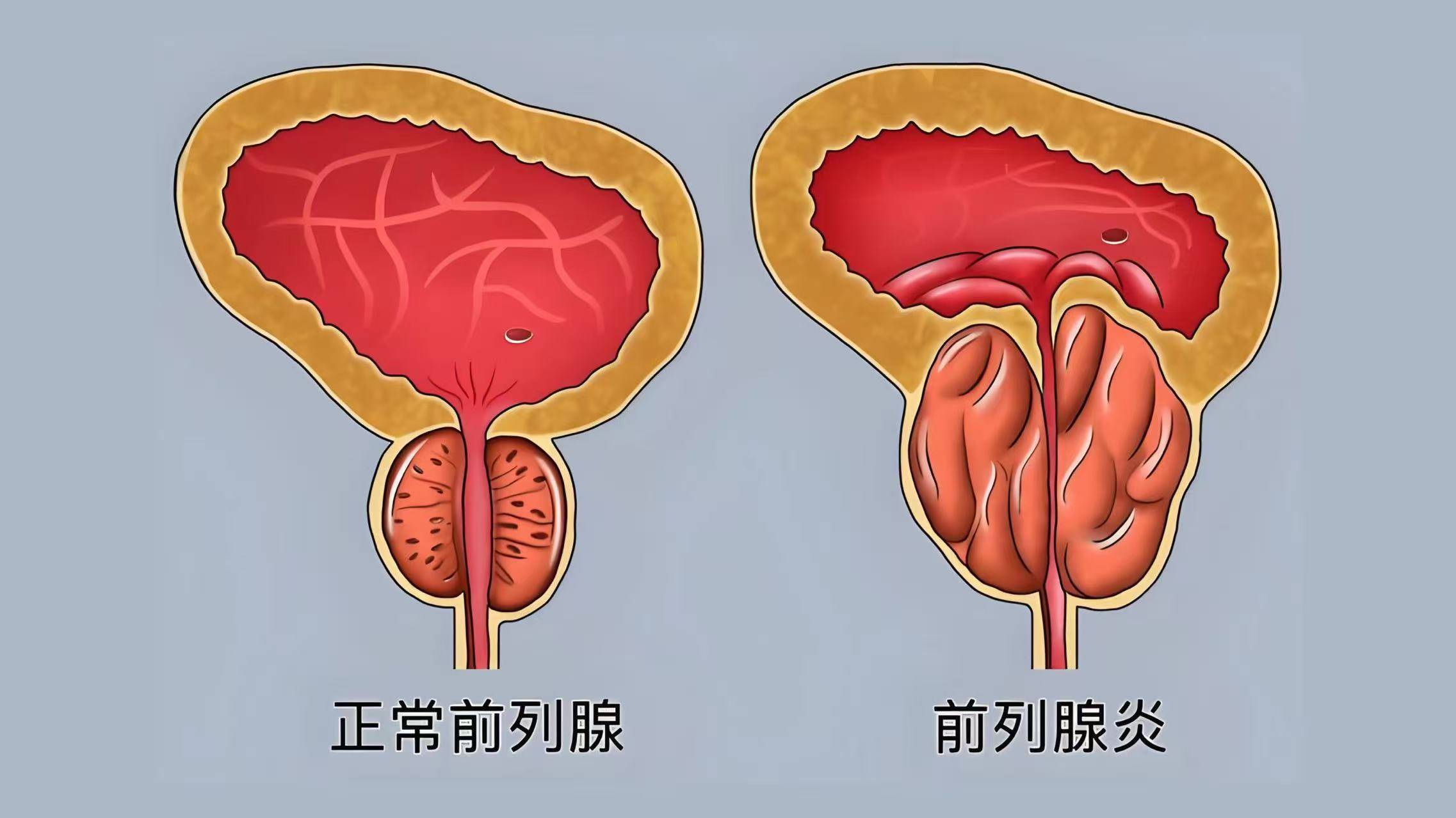 原创            奉劝男性：若不想被前列腺炎折磨下半生，尽早改掉这 6 大习惯！